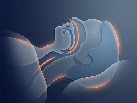 Custom anti-snoring oral device for quieter sleep